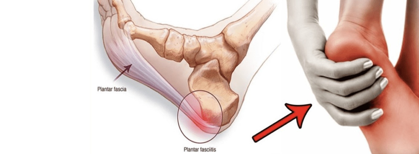 Plantar Fasciitis