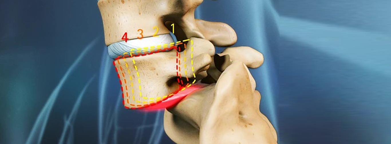 SpondylolysisandSpondylolisthesis