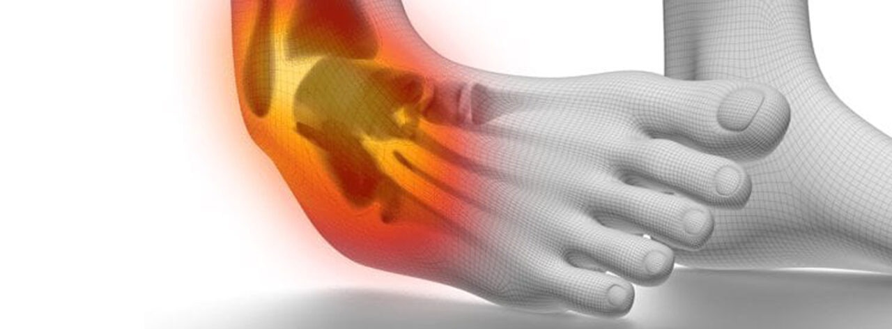 Sprained Ankle - Dr. Vaibhav Jain