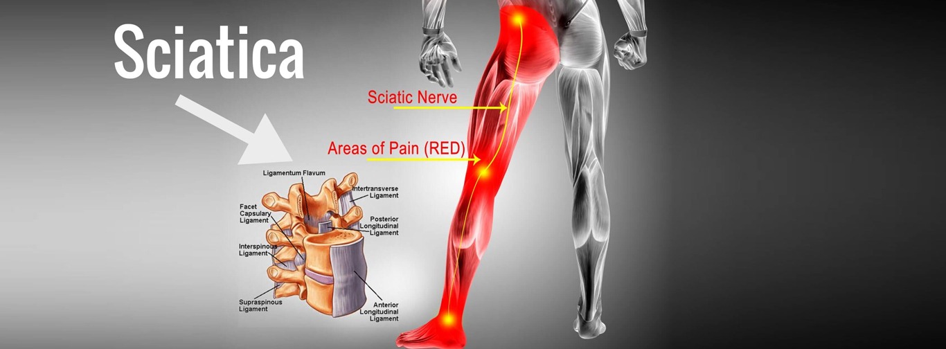 sciatica